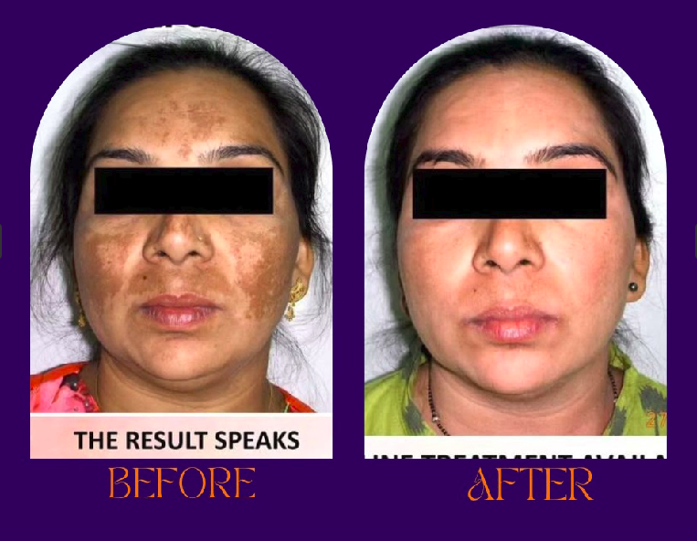 Side profile acne scar improvement